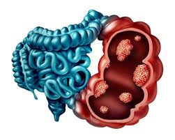 It is estimated that about 15,250 people are diagnosed with what are the symptoms? The Treatment Of Bowel Cancer Hunter Valley Oncology