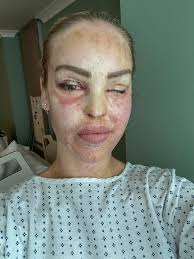 This is me! (For now) On Tuesday I had a planned operation, a Tarsorrhaphy  to my left eye. Tarsorrhaphy is the joining of part or all of the upper and  lower eyelids