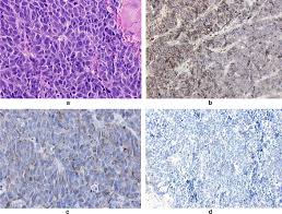 Merkel cell carcinoma (mcc) is a rare but aggressive neuroendocrine tumour of the skin with high rate of local recurrence and distant metastatic potential leading to poor outcomes. Merkel Cell Carcinoma In The Oral Cavity A Case Presentation And Review Of The Literature Sciencedirect