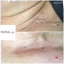 Finally a 100% natural way to remove cherry angiomas. Facebook