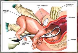 Image result for Forceps Assisted Delivery