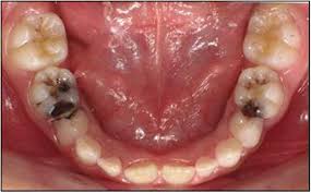 Common Dental Diseases In Children And Malocclusion International Journal Of Oral Science