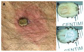 Image result for Tick Paralysis