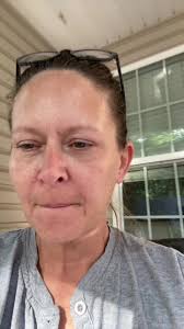 Car Lighter Scar Burn