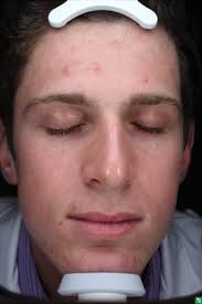 A PILOT STUDY TO ASSESS THE EFFICACY AND TOLERABILITY OF TWO NEW  PROPRIETARY, PURE HYPOCHLOROUS ACID-BASED (HOCL) TREATMENTS FO