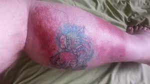 Tattoo Redness Why Is My New Tattoo Red Inflamed Authoritytattoo