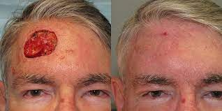 Skin cancers can look very different. Forehead Reconstruction Skin Cancer And Reconstructive Surgery Center