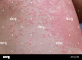 Image result for Photodermatitis