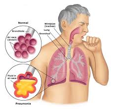 Pin On Dysphagia