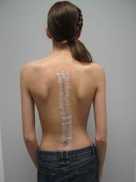 Scoliosis Surgery Recovery Blog Top Pinterest Pick By Scoliosiswatch Co Uk Scoliosis Surgery Scoliosis Surgery Recovery