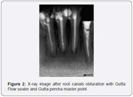 It is a dental abscess that can occur immediately following root canal treatment. Open Access Dentistry And Oral Journals With High Impact Factor List