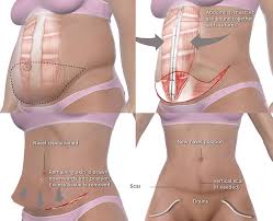 Maybe you would like to learn more about one of these? Drain Free Tummy Tuck Toronto Abdominoplasty All Female Staff