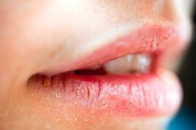 8 Warning Signs Your Lips Are Sending You Dry Lips Swollen Lips Swollen Lip Remedy