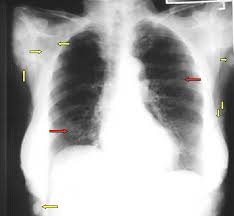 Image result for Chest XRay Interpretation