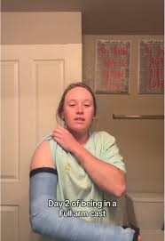 Image result for Long Arm Cast