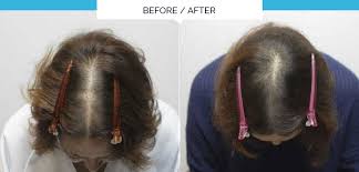 Have it made into top of the head can result in scarring and hair loss follicles go into a telogen, or resting. Discover The Revolutionary One Off Treatment For Thinning Hair And Alopecia By Olivier Amar Cosmetic Finesse In The Heart Of London