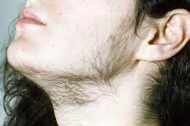 Just apply it to the areas that need to be treated, after 2.5 mins do a patch test to check how long you have to keep it. Acne And Facial Hair Dr Health Clinic