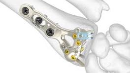 Acu-Loc 2 Wrist Plating System | Acumed