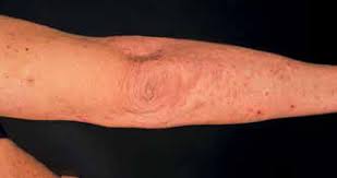 Scielo Brasil Skin Symptoms As Diagnostic Clue For Autoinflammatory Diseases Skin Symptoms As Diagnostic Clue For Autoinflammatory Diseases