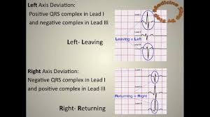 11 steps to read an ecg ekg