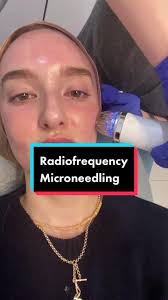 My Third Radio Frequency Microneedling Appointment Experience