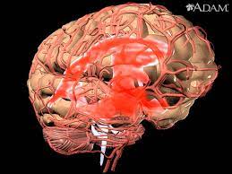 Learn vocabulary, terms and more with flashcards, games and dilataciones focales anormales de una arteria cerebral con adelgazamiento de la pared vascular. Spanish Hie Multimedia Aneurisma En El Cerebro