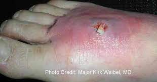 Staph skin infections, including mrsa, generally start as swollen, painful red bumps that might look like pimples or spider bites. Mrsa Communicable Diseases Public Health Environmental Health Safety Protect Iu Indiana University