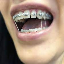 Latest Teeth Braces Colors Ideas Cute Girl Teeth Braces Braces Colors Metal Braces