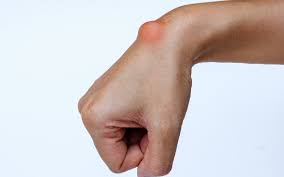 Image result for Cyst