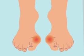 Repeated strain to the foot joint with years of walking or dancing or after examination, the painful lump on top of her foot was diagnosed as a bone spur by the doctor. Bunion Misdiagnosis Health Problems You Can Mistake For Bunions