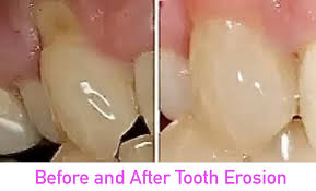 Image result for Tooth Abrasion