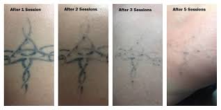Your laser treatment coordinator can go over the specific details of your tattoo removal needs once you've had a consultation. Tattoo 101 Part 9 Laser Tattoo Removal Process Steemit