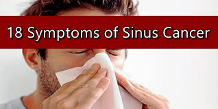Cancers of the nasal cavity and paranasal sinuses present much the same as noncancerous conditions affecting this area (think upper because the symptoms of nasal cavity and paranasal sinus cancers can be pretty nonspecific—particularly early on—an ent physician, or. Sinus Cancer Symptoms 18 Signs Of Nasal Cavity Cancers