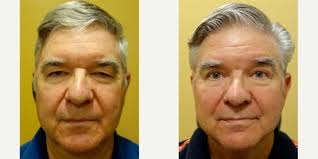 Jeffrey M. Joseph, MD, Oculoplastic Surgeon, Board Certified in  Ophthalmology