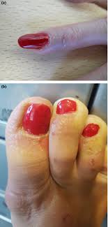nail cosmetics a dermatological