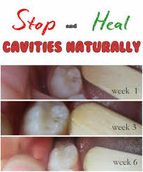 After reading my overview of how to prevent tooth decay naturallyin bothtoddlers & adults, you must have gained some valuable knowledge to avoid cavities. Beautytutorials Org Is Expired Or Suspended Heal Cavities Cure Cavities Naturally Natural Cavity Remedy