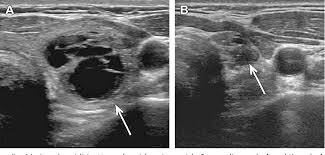 Ultrasound exposes you to no radiation whatsoever. Figure 17 From Thyroid Ultrasound Part 1 Technique And Diffuse Disease Semantic Scholar