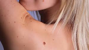 What kind of treatment will i need? Skin Cancer On Your Scalp Feet And Lips Molesafe