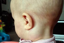 Lymph nodes, which are small nodules found throughout your body, are an integral part of your immune system. How To Treat Inflammation Of The Lymph Nodes Behind The Ear The Child Has A Swollen Lymph Node Behind The Ear