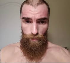 Daniel Munro's Journey: Triumphing Over Atopic Dermatitis with the  Carnivore Diet