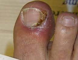 Learn about the features, types, and treatment of skin diseases in this article. Nail Disease Wikipedia