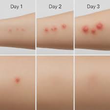 Image result for bedbug bites look like