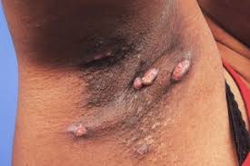 It is usually due to an infection of a sweat gland caused by an ingrown hair. Hidradenitis Suppurativa Hs Nhs