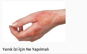 Yanik Izi Nasil Gecer Yanik Izine Ne Iyi Gelir Cilt Bakimi Cilt Bakimi Iz Bakken