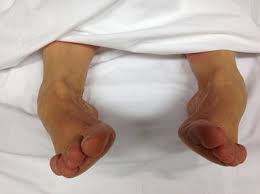 Image result for Tetany