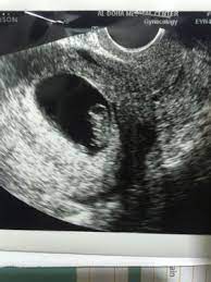 شكل كيس الحمل كيس الحمل