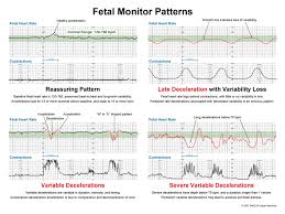 Maternal Child Health Ob Fetal Heart Tones Acronym Child Nursing Pediatric Nursing Newborn Nursing