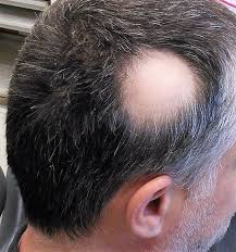 Both of my parents have low blood pressure too, for what it's worth. 5 Common Causes Of Hair Loss Everyone Should Know Dream Hair