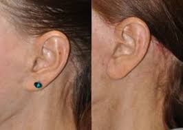 Early revision in 1982, a group of researchers, reportedly for the first time, described a minimally invasive pixie ear revision surgery. Pixie Ear Before And After Photos Dr Brent Beverly Hills