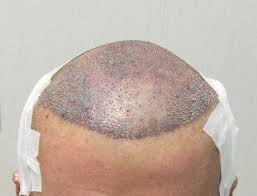 A hurricane and marketing woes couldn't keep these persistent franchisees down. Foto Trapianto Capelli Prima E Dopo Masullo Medical Group